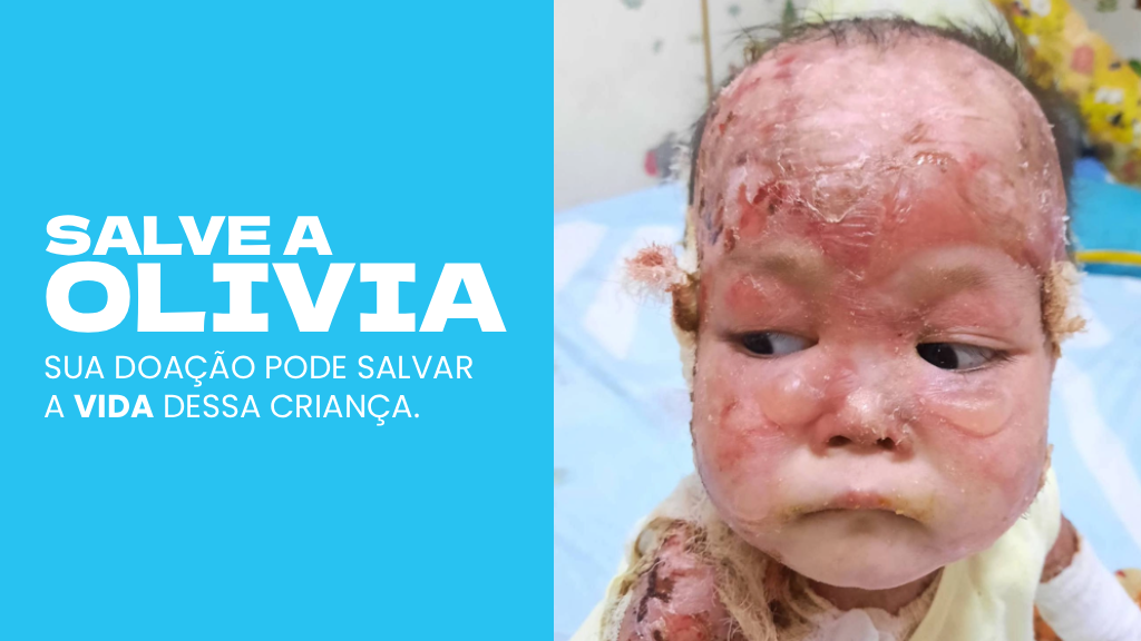 Ajude a Olivia no tratamento contra a Epidermólise Bolhosa